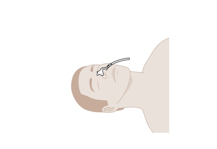 NOVO Nasal-Fix  -8,2 x 7 cm (80 pcs)